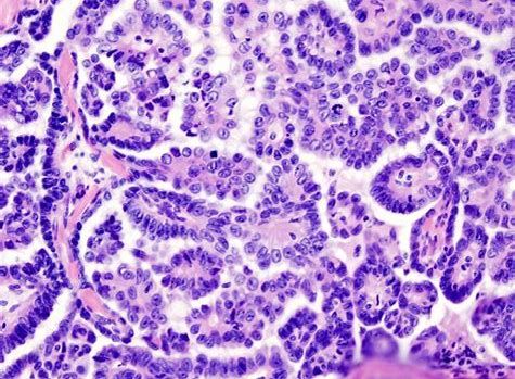 CancerRes：新研究發(fā)現(xiàn)幫助清除癌癥干細(xì)胞的新靶標(biāo)